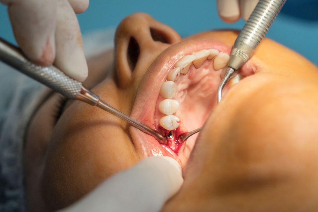 dental implant in istanbul (7)