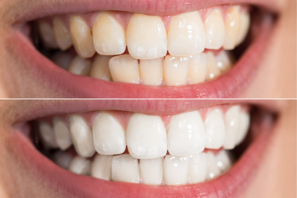 teeth whitening in istanbul (2)
