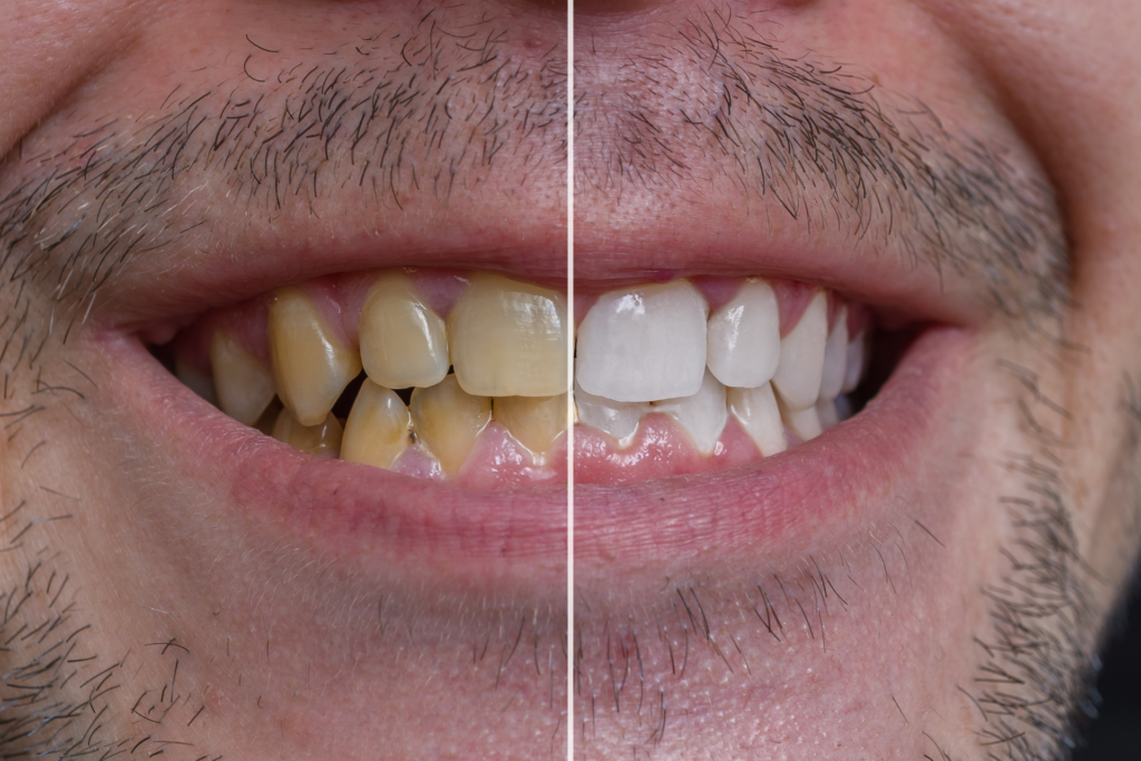 teeth whitening in istanbul (4)