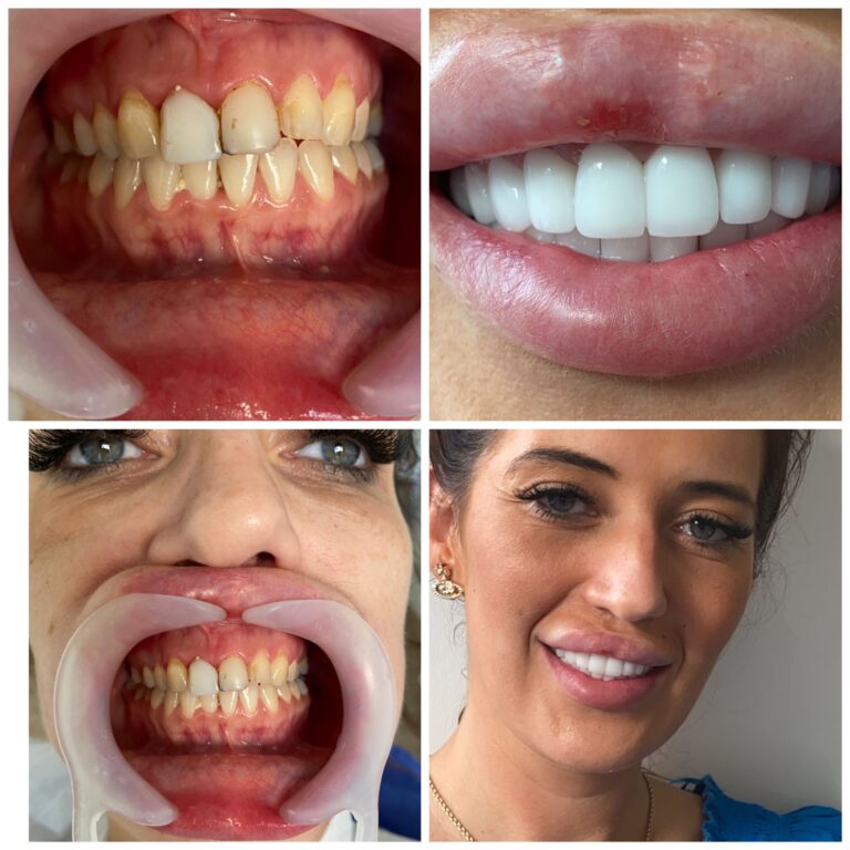 hollywood smile before & after5