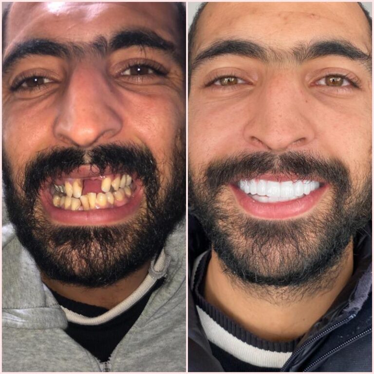 hollywood smile before & after2