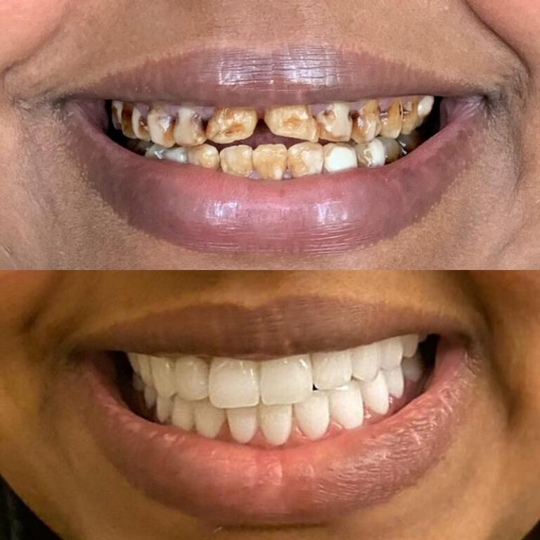 hollywood smile before & after4