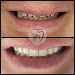 dental treatments istanbul8