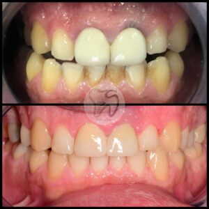 dental treatments istanbul5