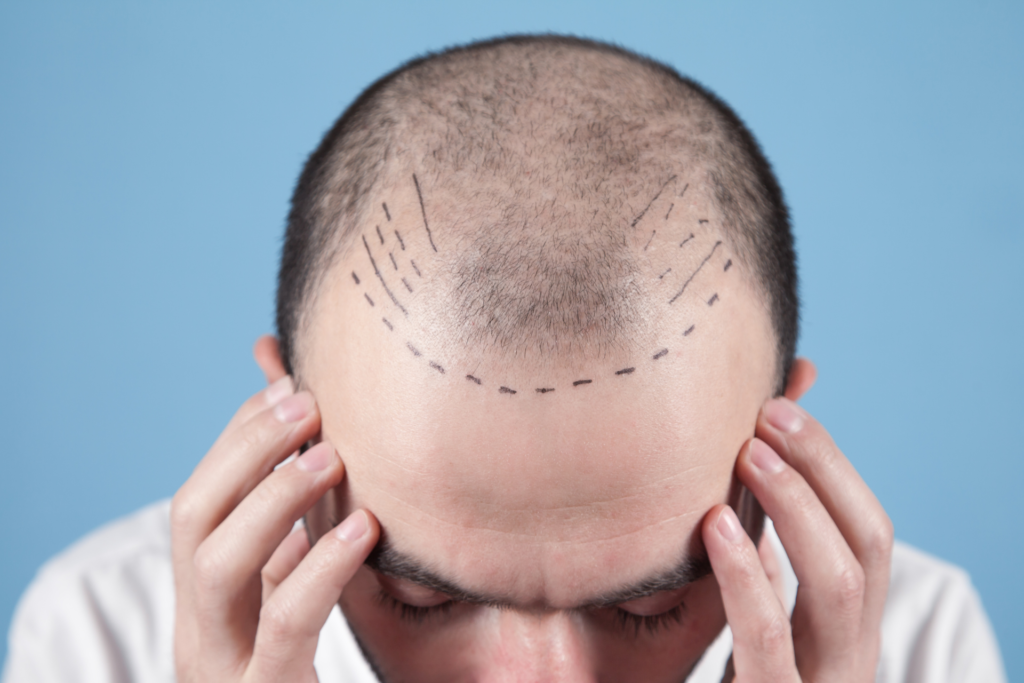 hair transplant in istanbul1