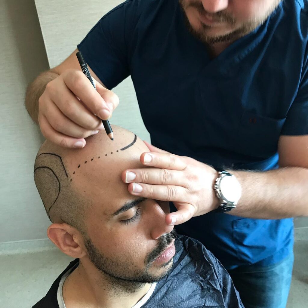 how much does a hair transplant cost