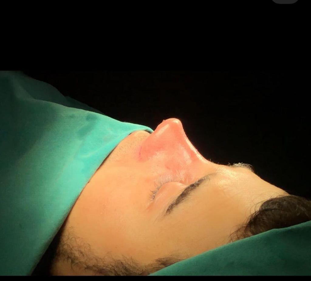 rhinoplasty nose job in istanbul (1)