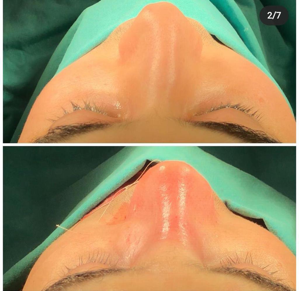 rhinoplasty nose job in istanbul (2)