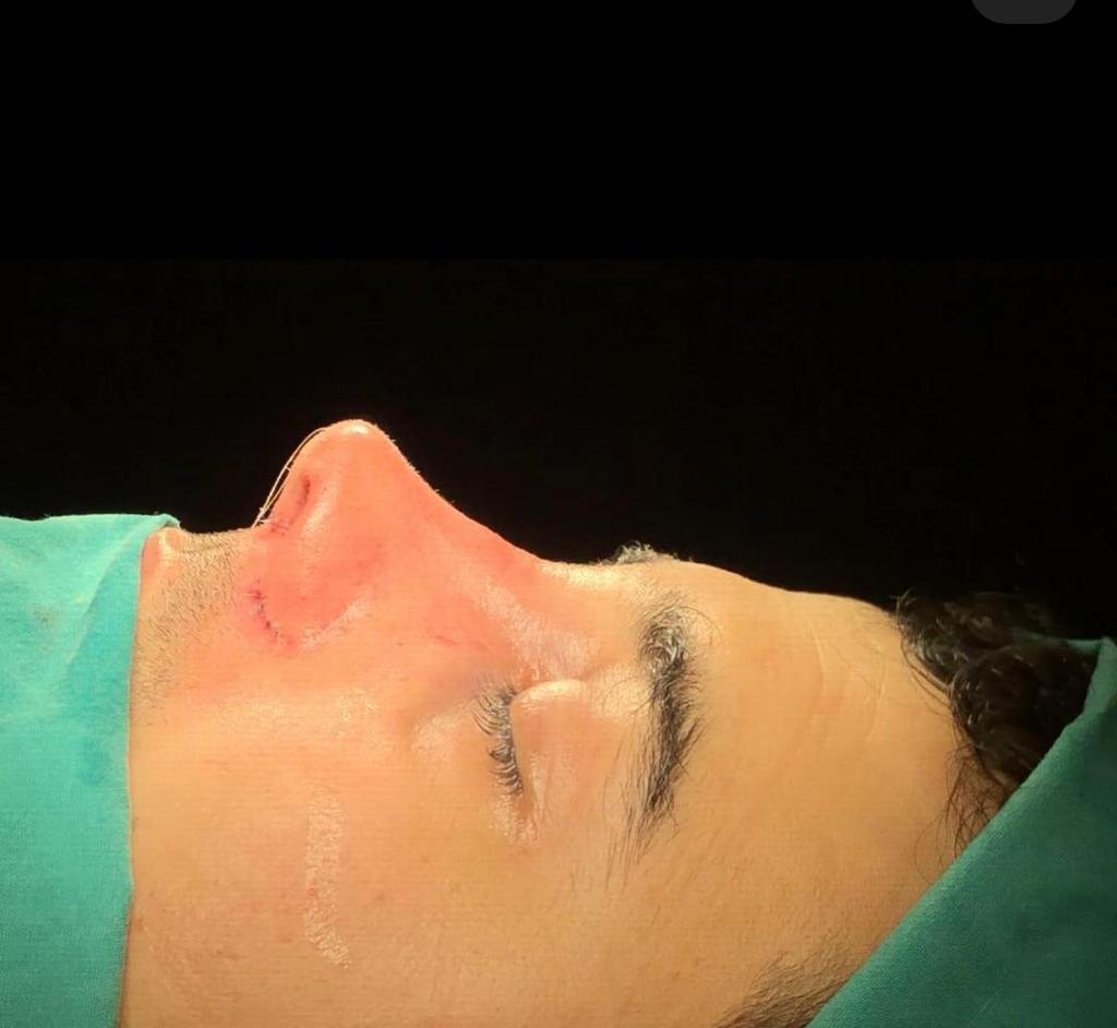 rhinoplasty nose job in istanbul (3)