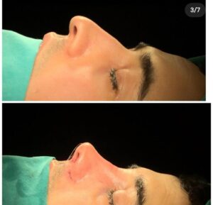 rhinoplasty nose job in istanbul (4)