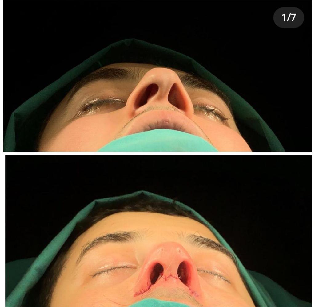 rhinoplasty nose job in istanbul (5)