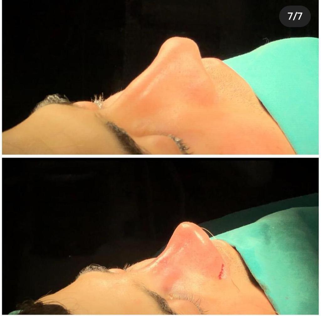 rhinoplasty nose job in istanbul (7)